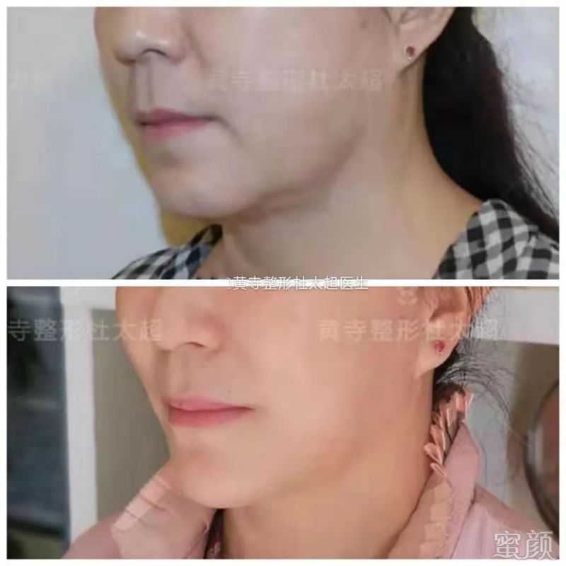 https://img.yiyiaimei.com/mnt/timg/200313/125K24110-5.jpg 案例图片