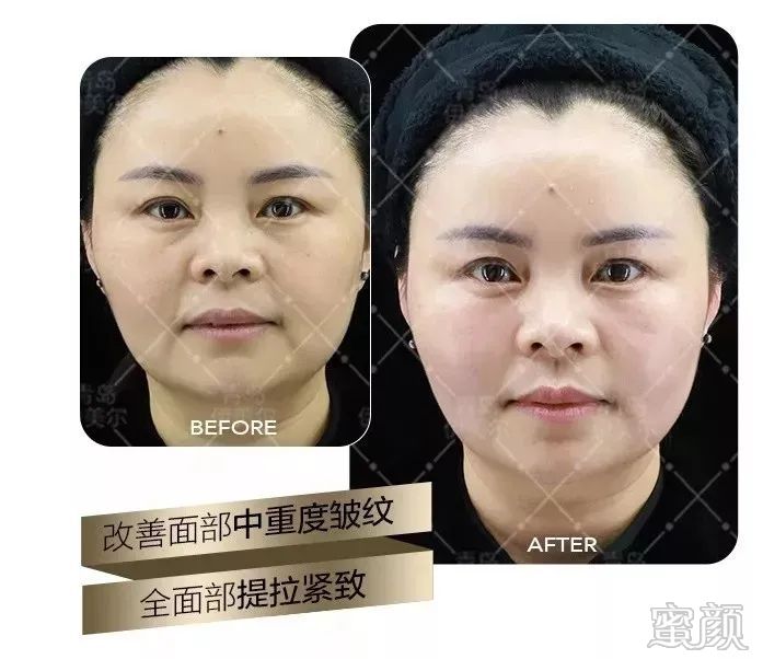 https://img.yiyiaimei.com/mnt/timg/200314/1446015033-3.jpg 案例图片