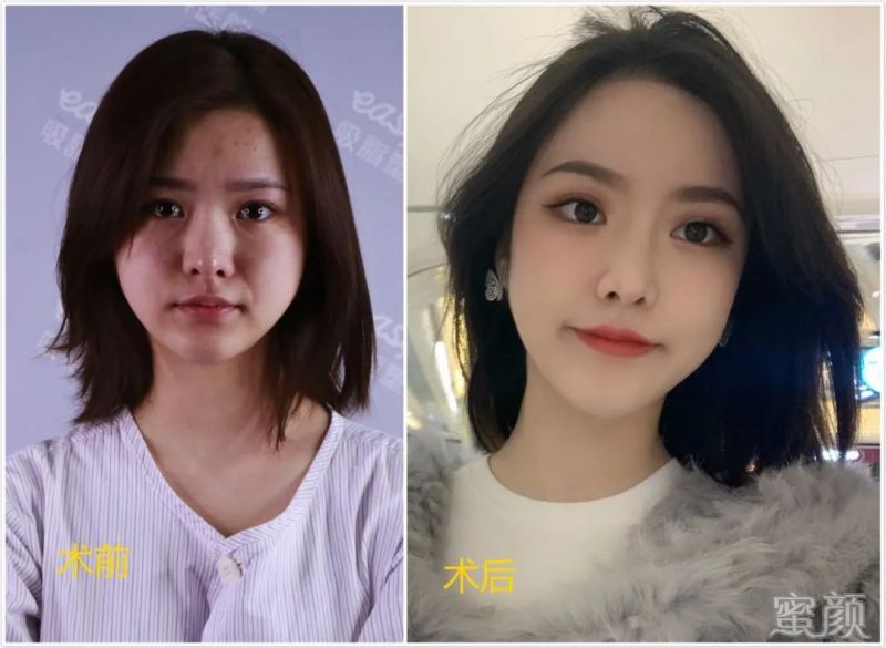 https://img.yiyiaimei.com/mnt/timg/200318/143511O22-14.jpg 案例图片