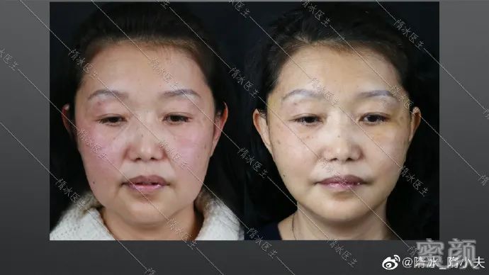 https://img.yiyiaimei.com/mnt/timg/200318/1510191U1-0.jpg 案例图片
