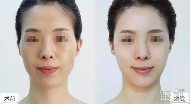 https://img.yiyiaimei.com/mnt/timg/200320/1514195I1-3.jpg 案例图片