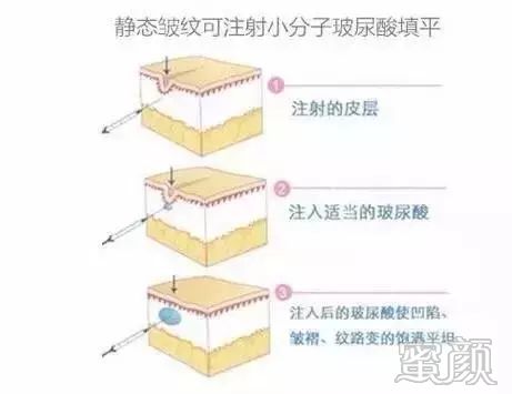 https://img.yiyiaimei.com/mnt/timg/200320/15141aN9-2.jpg 案例图片