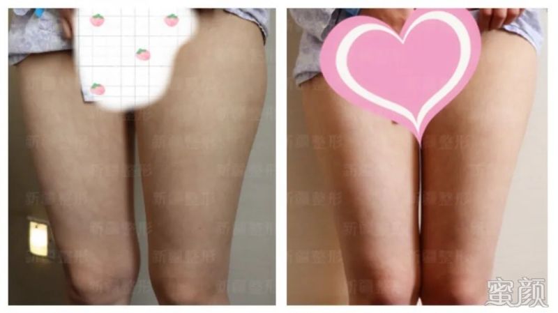 https://img.yiyiaimei.com/mnt/timg/200326/12255V543-5.jpg 案例图片