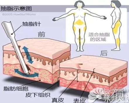 https://img.yiyiaimei.com/mnt/timg/200326/1K3043194-2.jpg