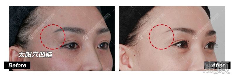 https://img.yiyiaimei.com/mnt/timg/200328/1309221009-7.jpg 案例图片