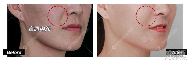 https://img.yiyiaimei.com/mnt/timg/200328/1309242462-15.jpg 案例图片