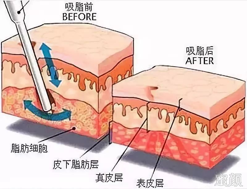 https://img.yiyiaimei.com/mnt/timg/200330/14110122M-1.jpg 案例图片
