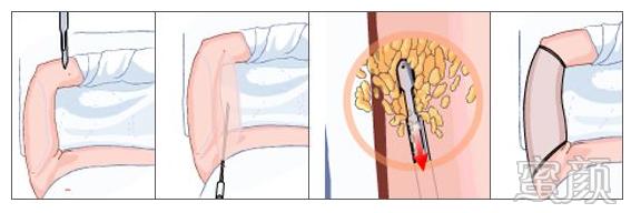 https://img.yiyiaimei.com/mnt/timg/200407/1Z2112393-3.jpg 案例图片