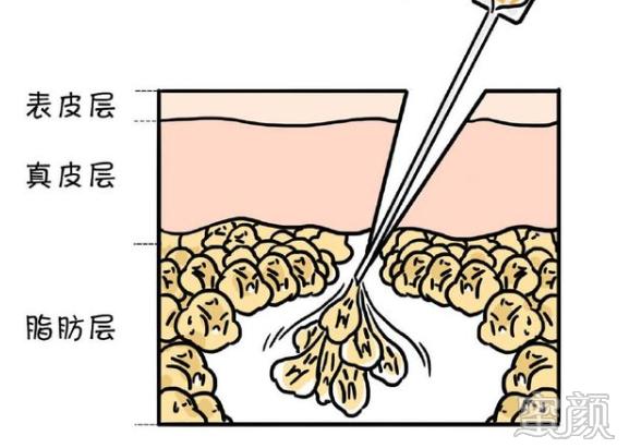 https://img.yiyiaimei.com/mnt/timg/200407/1Z2134918-4.jpg 案例图片