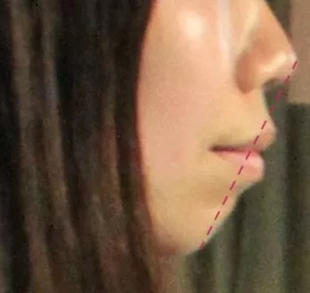 https://img.yiyiaimei.com/mnt/timg/200408/13455G594-3.jpg 案例图片