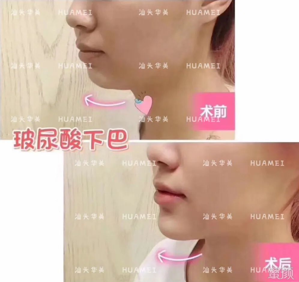https://img.yiyiaimei.com/mnt/timg/200408/13455M592-4.jpg 案例图片