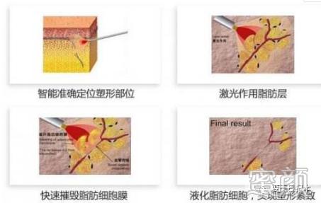 https://img.yiyiaimei.com/mnt/timg/200411/1U23B323-2.jpg 案例图片