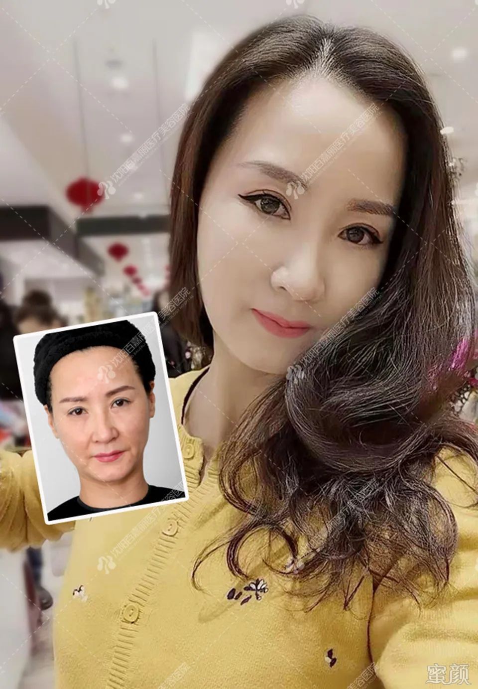 https://img.yiyiaimei.com/mnt/timg/200413/1321092606-6.jpg 案例图片