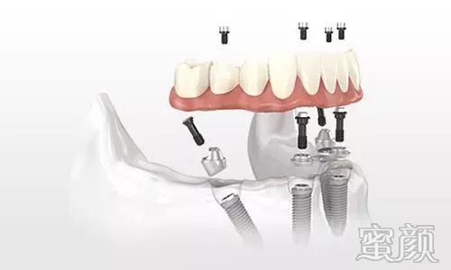 https://img.yiyiaimei.com/mnt/timg/200414/142P930A-3.jpg