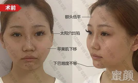 https://img.yiyiaimei.com/mnt/timg/200415/134H640T-2.jpg 案例图片