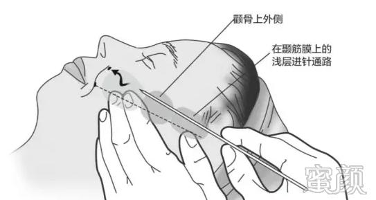 https://img.yiyiaimei.com/mnt/timg/200415/15012A592-2.jpg 案例图片