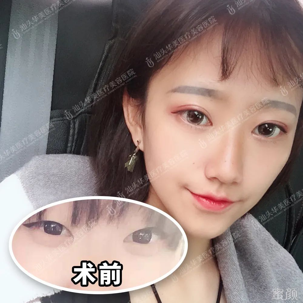 https://img.yiyiaimei.com/mnt/timg/200415/1543001520-11.jpg 案例图片