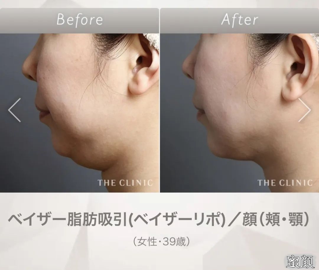 https://img.yiyiaimei.com/mnt/timg/200417/1333412050-1.jpg 案例图片
