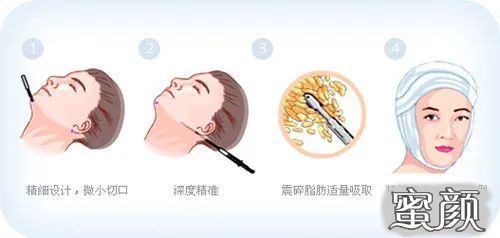 https://img.yiyiaimei.com/mnt/timg/200417/133450A41-3.jpg 案例图片