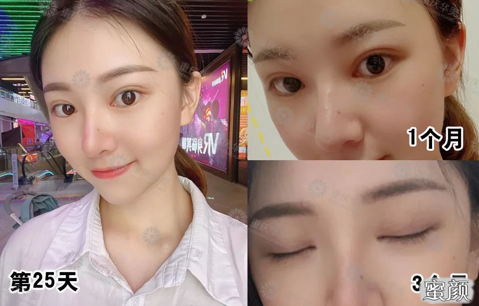 https://img.yiyiaimei.com/mnt/timg/200418/1336495336-5.jpg 案例图片