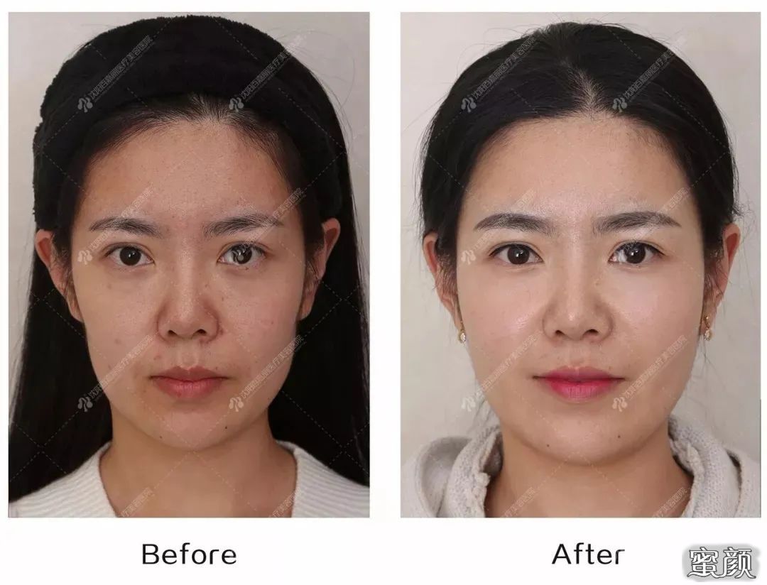 https://img.yiyiaimei.com/mnt/timg/200420/13012BO3-7.jpg 案例图片