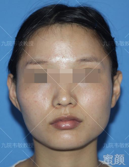 https://img.yiyiaimei.com/mnt/timg/200427/135UQ360-1.jpg 案例图片