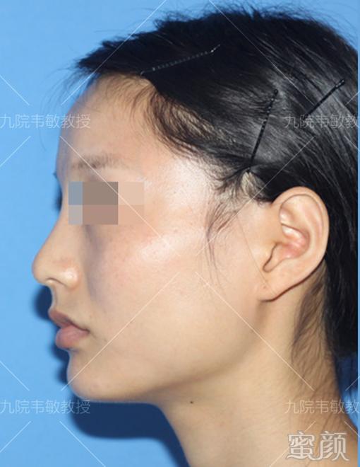 https://img.yiyiaimei.com/mnt/timg/200427/135Z14405-2.jpg 案例图片