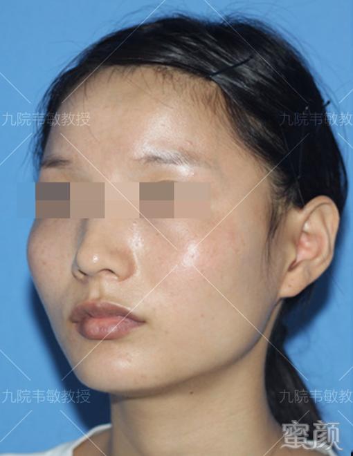 https://img.yiyiaimei.com/mnt/timg/200427/135Z4O63-3.jpg 案例图片