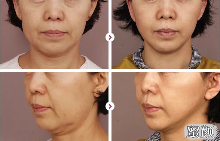 https://img.yiyiaimei.com/mnt/timg/200429/14323154B-7.jpg 案例图片