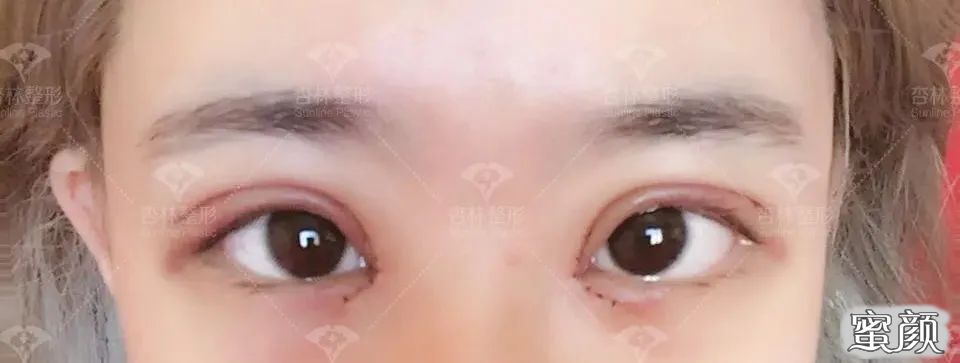 https://img.yiyiaimei.com/mnt/timg/200503/115QL106-5.jpg 案例图片