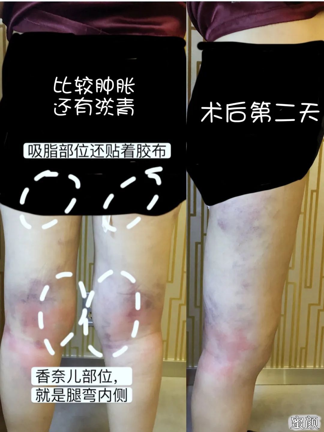 https://img.yiyiaimei.com/mnt/timg/200506/1320032322-5.jpg 案例图片