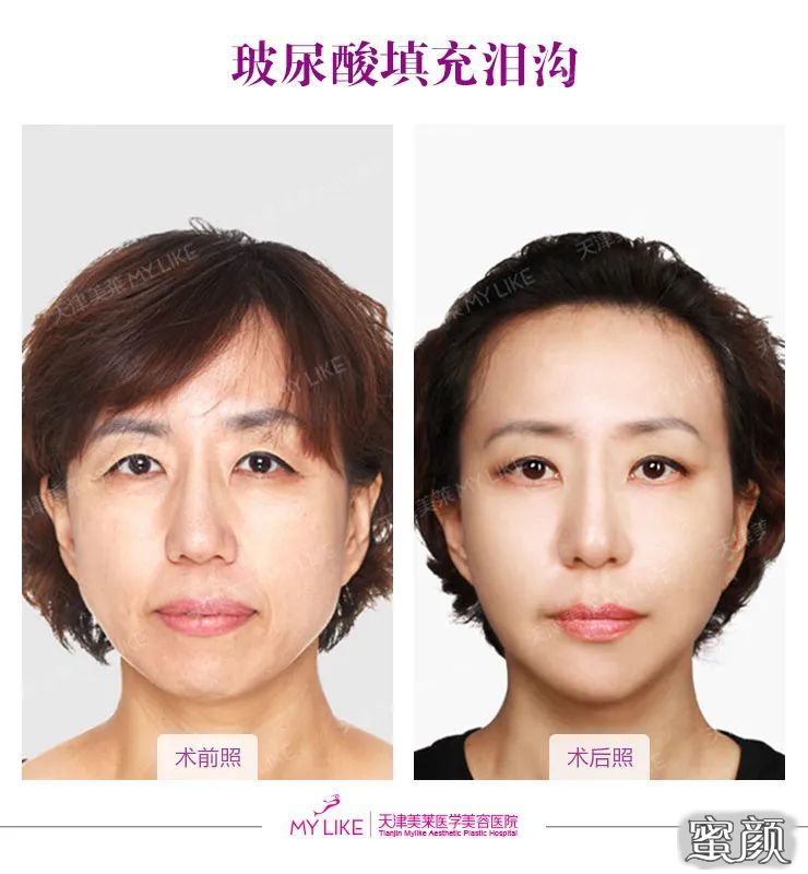 https://img.yiyiaimei.com/mnt/timg/200506/135U344O-0.jpg 案例图片