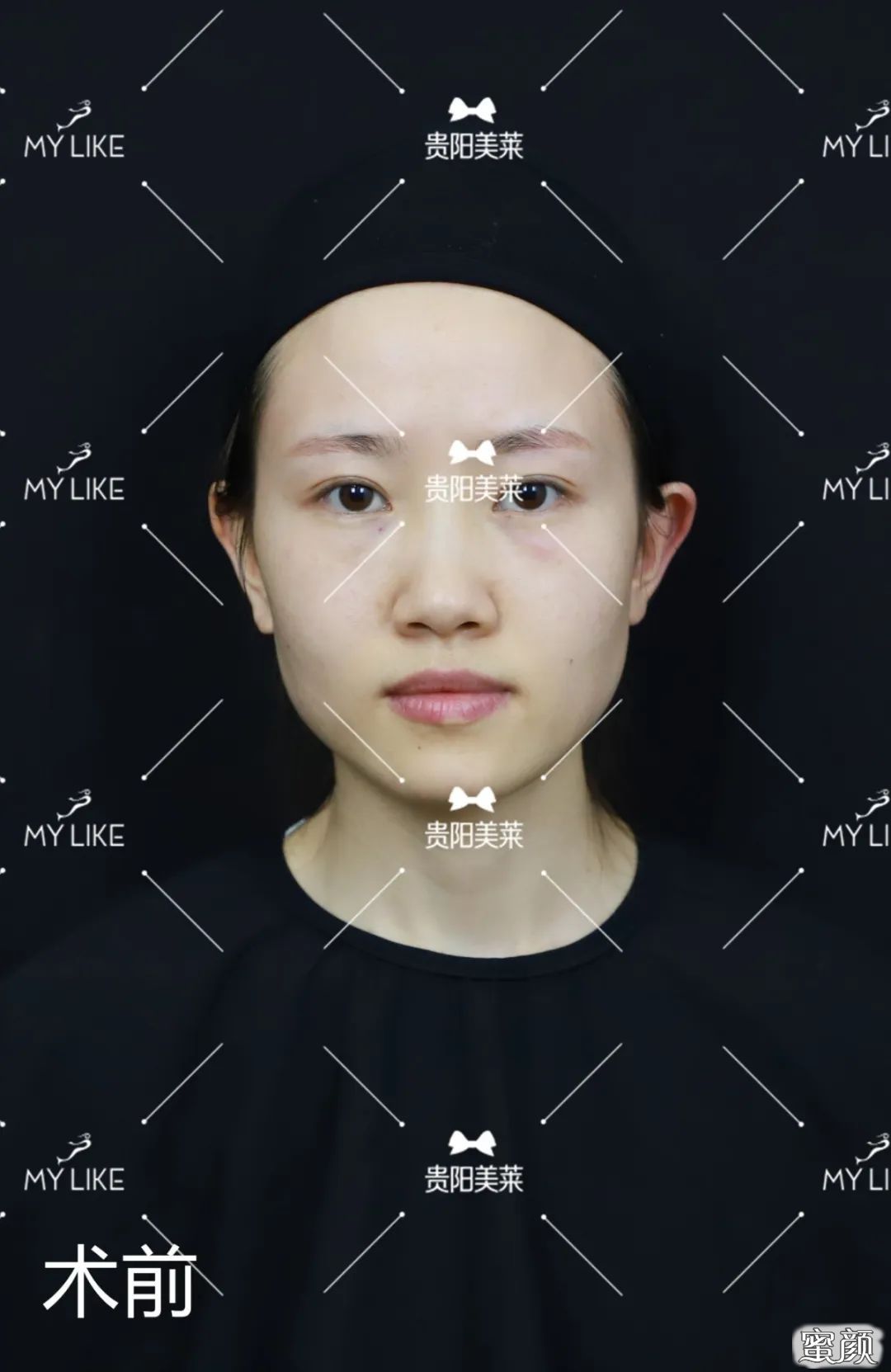https://img.yiyiaimei.com/mnt/timg/200507/14204C411-1.jpg 案例图片