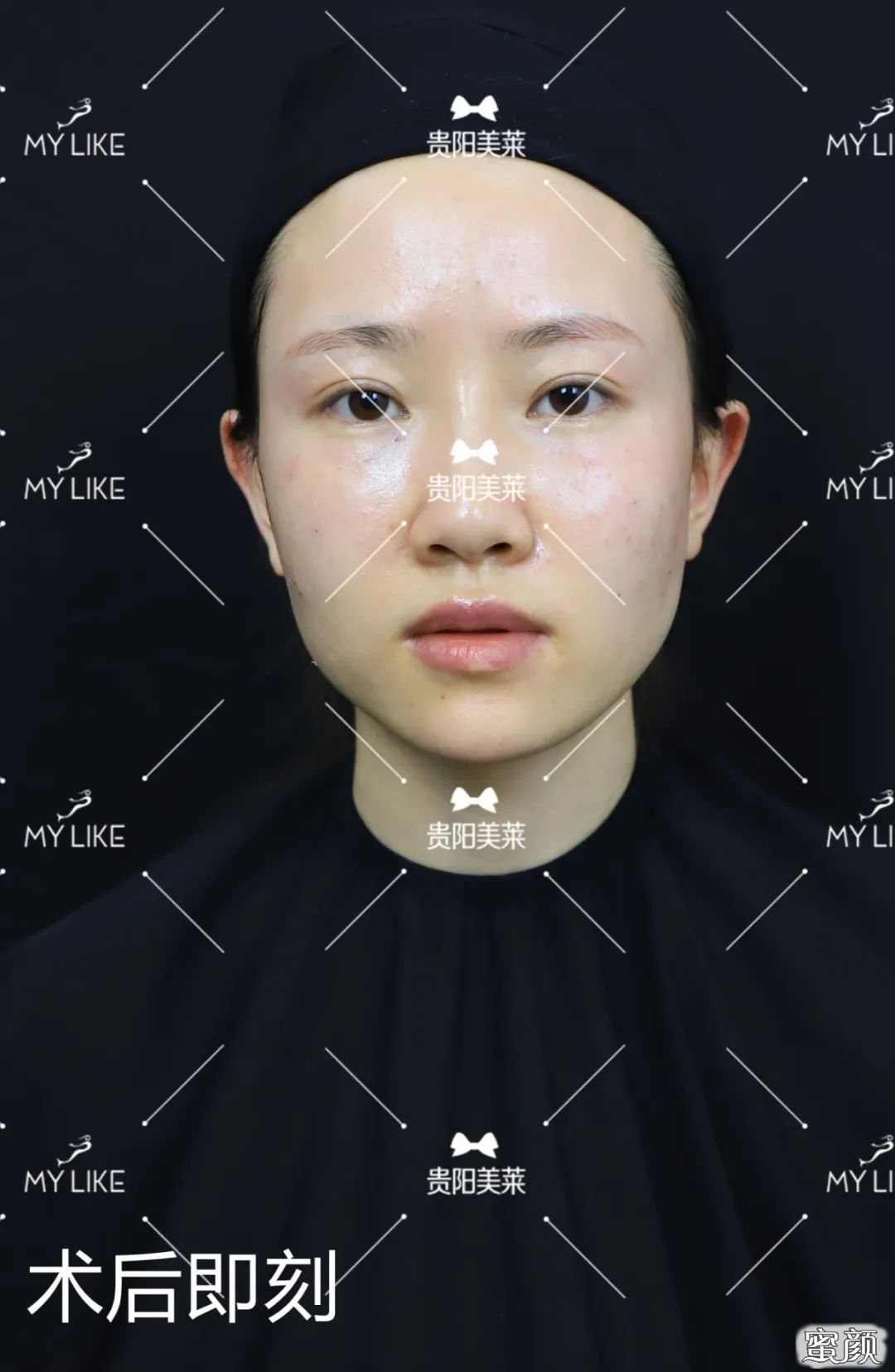 https://img.yiyiaimei.com/mnt/timg/200507/14204M400-2.jpg 案例图片