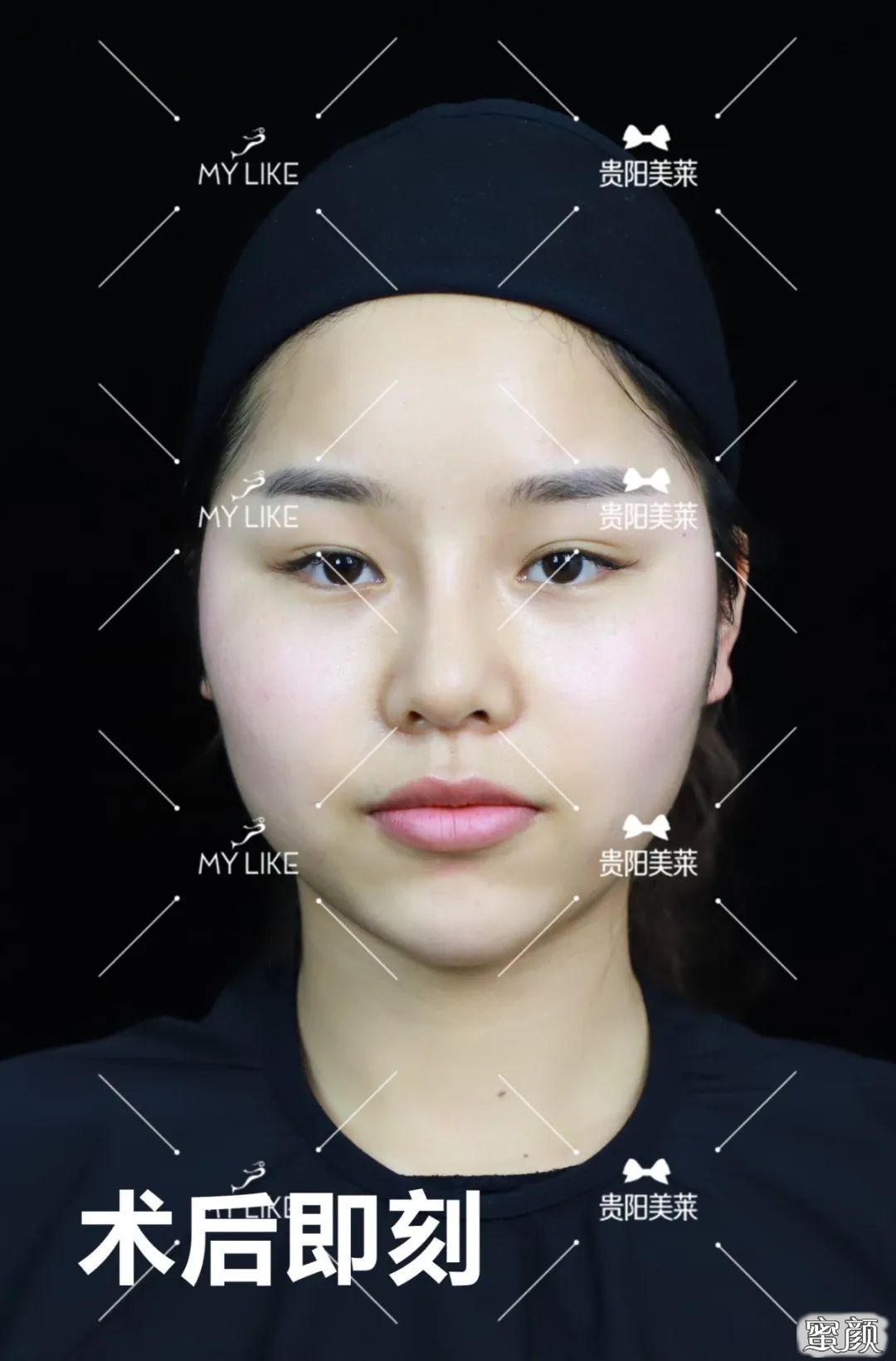 https://img.yiyiaimei.com/mnt/timg/200507/1420531J9-5.jpg 案例图片