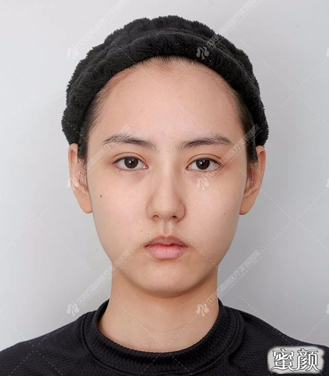 https://img.yiyiaimei.com/mnt/timg/200512/15110364Y-1.jpg 案例图片