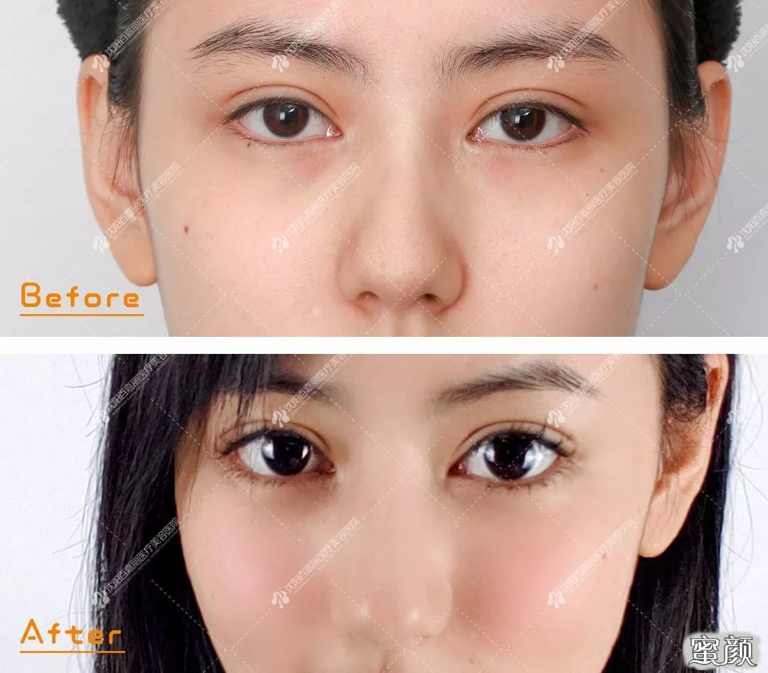 https://img.yiyiaimei.com/mnt/timg/200512/1511061Z3-5.jpg 案例图片
