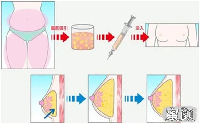 https://img.yiyiaimei.com/mnt/timg/200514/14302344L-9.jpg 案例图片