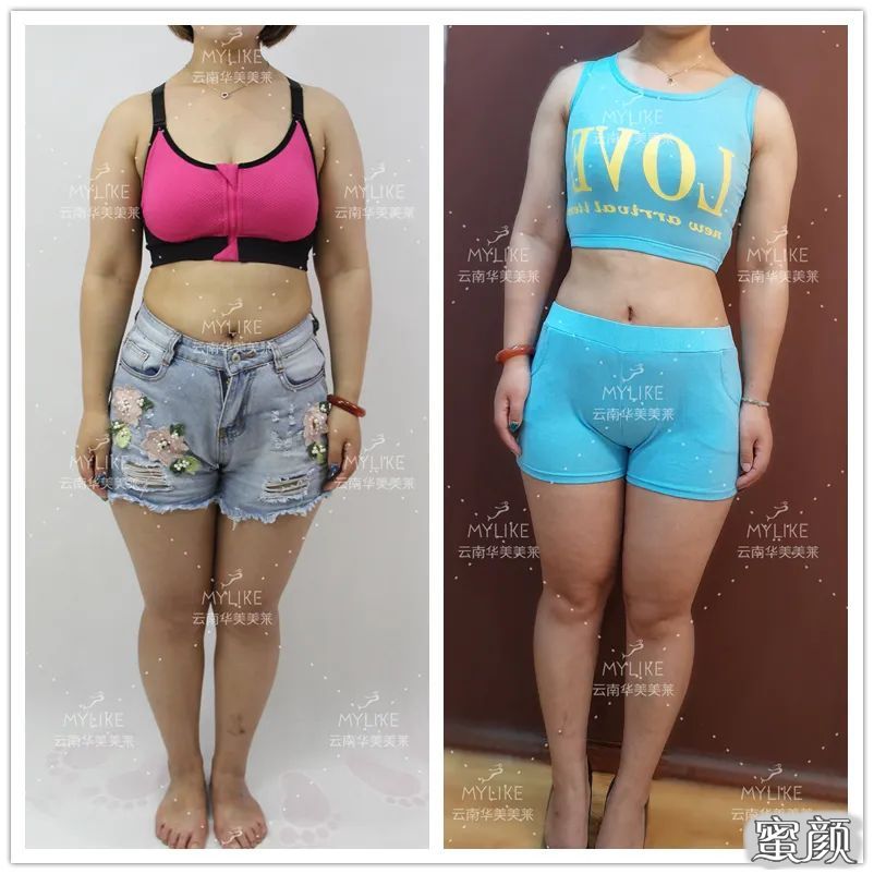 https://img.yiyiaimei.com/mnt/timg/200515/140K21L0-1.jpg 案例图片