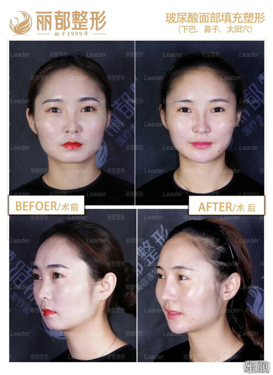 https://img.yiyiaimei.com/mnt/timg/200517/13550J950-2.jpg 案例图片