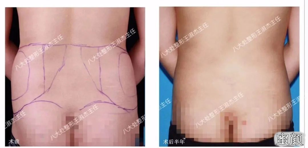 https://img.yiyiaimei.com/mnt/timg/200526/111Z23042-0.jpg 案例图片