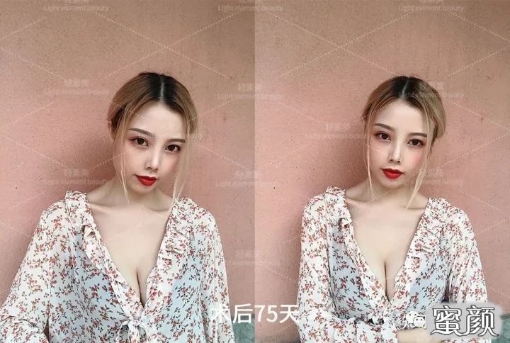 https://img.yiyiaimei.com/mnt/timg/200605/11423MO3-3.jpg 案例图片