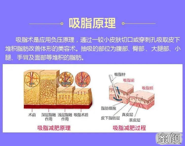 https://img.yiyiaimei.com/mnt/timg/200606/131G2I91-2.jpg 案例图片