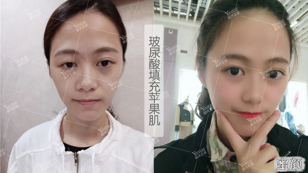 https://img.yiyiaimei.com/mnt/timg/200607/114IQ064-4.jpg 案例图片