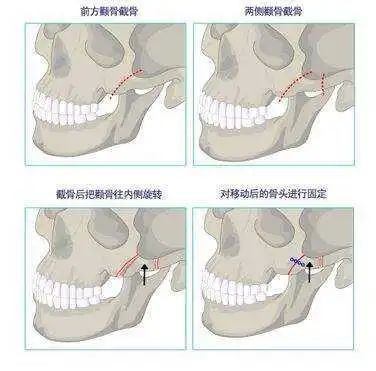 https://img.yiyiaimei.com/mnt/timg/200611/114R012O-2.jpg 案例图片