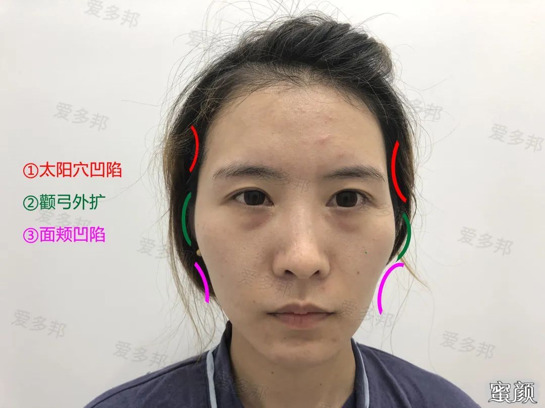 https://img.yiyiaimei.com/mnt/timg/200611/114R245T-3.jpg 案例图片