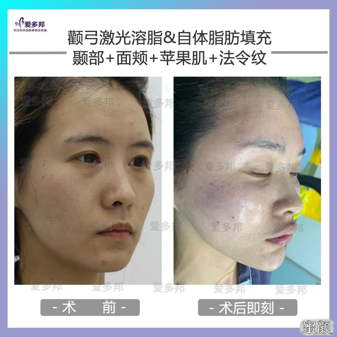 https://img.yiyiaimei.com/mnt/timg/200611/114R63000-5.jpg 案例图片
