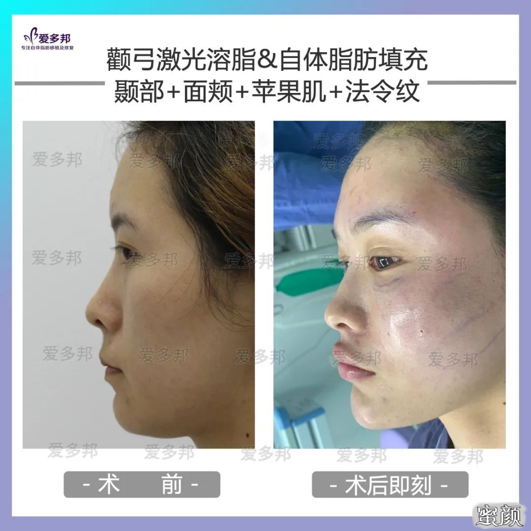 https://img.yiyiaimei.com/mnt/timg/200611/114RJ301-6.jpg 案例图片