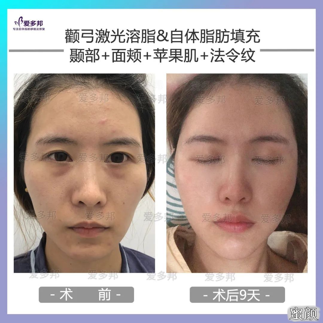 https://img.yiyiaimei.com/mnt/timg/200611/114RTH2-7.jpg 案例图片