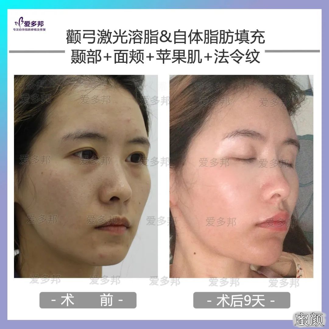https://img.yiyiaimei.com/mnt/timg/200611/114RaM9-8.jpg 案例图片